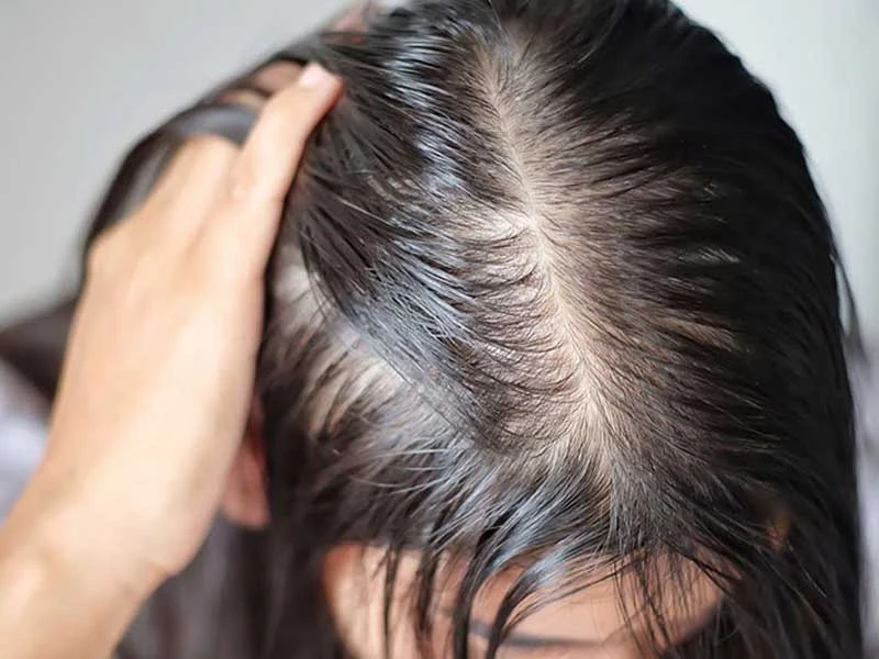 Ưu điểm và nhược điểm của cấy tóc tự thân và điêu khắc phun xăm chân tóc